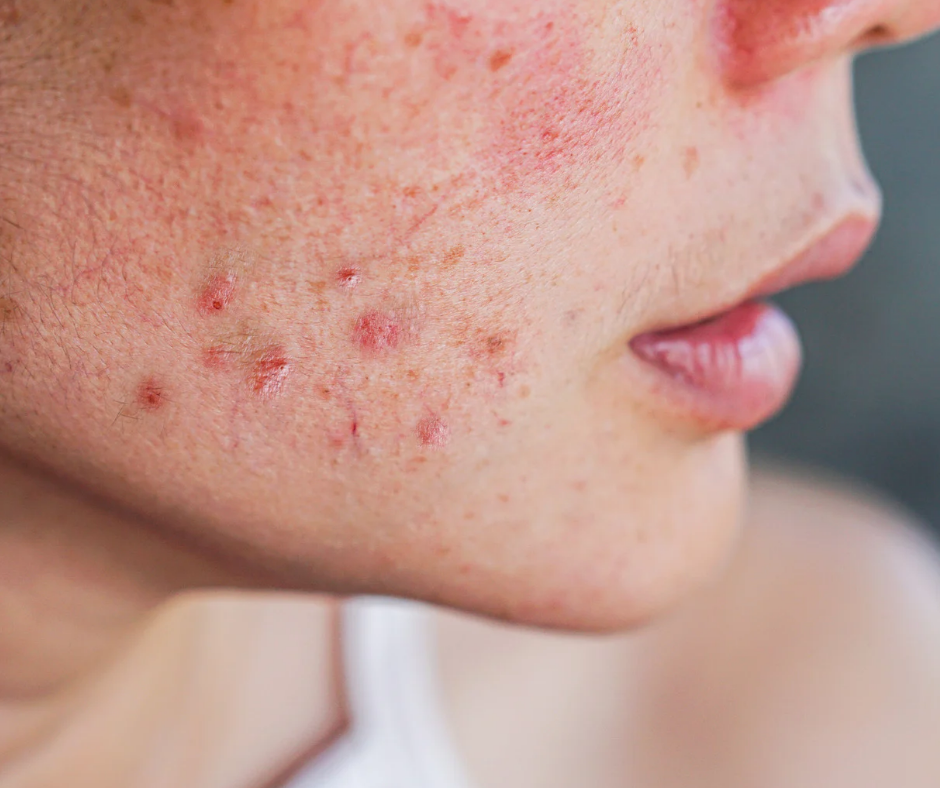 Acne Prone skincare